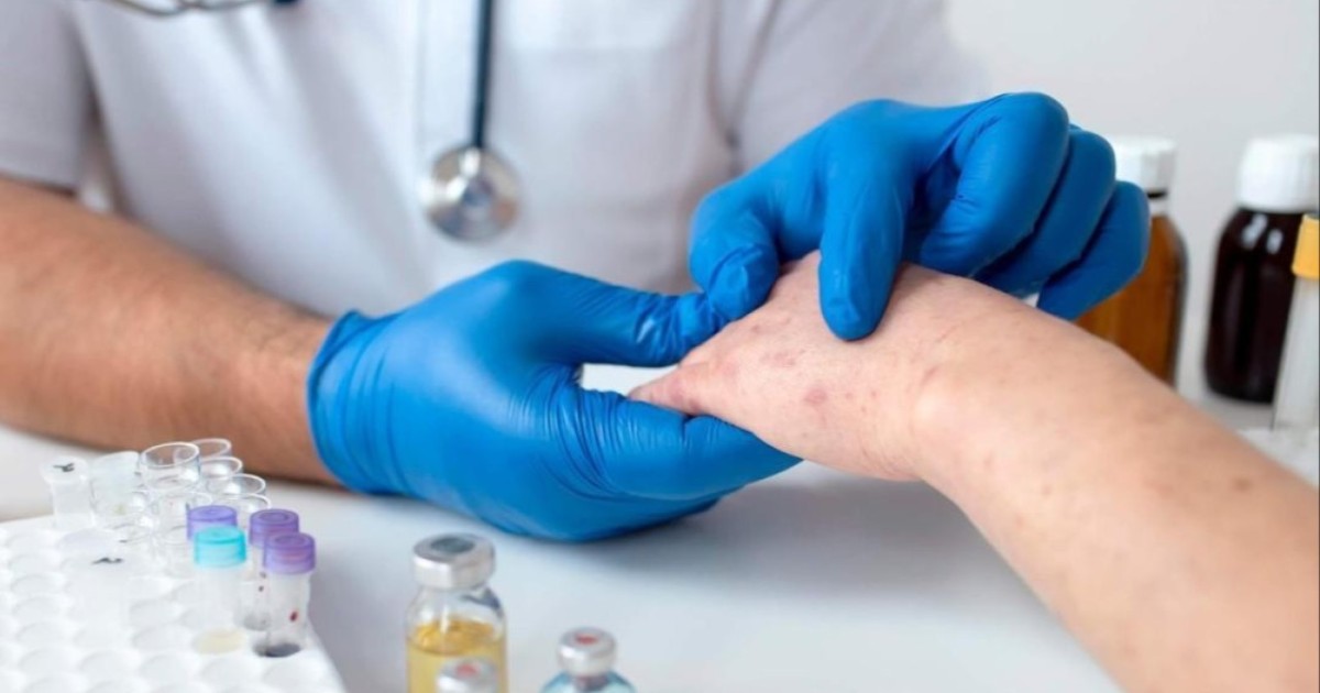 Елордада жыл басынан бері 380-нен астам адам қызылшамен ауырған