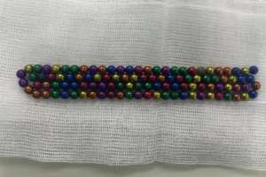 Дәрігерлер екі жасар сәбидің асқазанынан 105 түйір моншақ алды